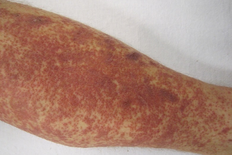 Vasculitis